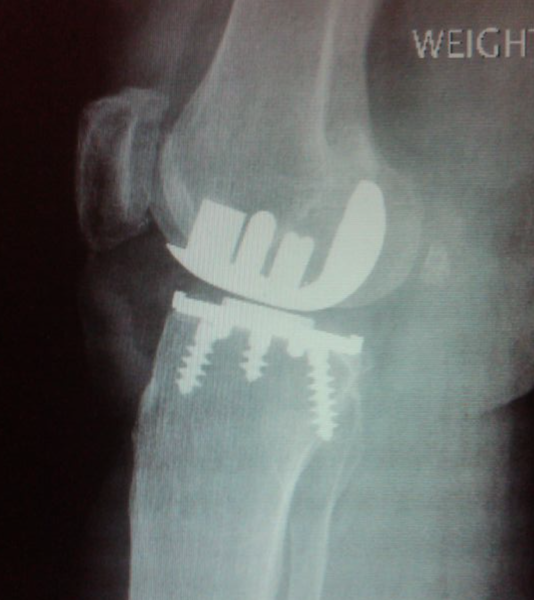 Whitesides Ortholoc II Unicompartmental Knee Prosthesis (Implant 4214)
